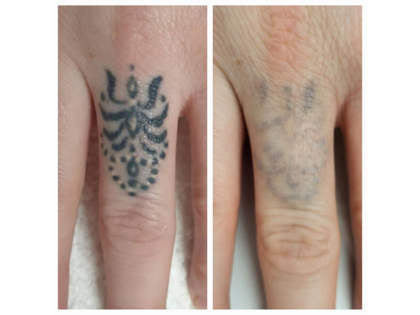 Tattoo or PMU removal